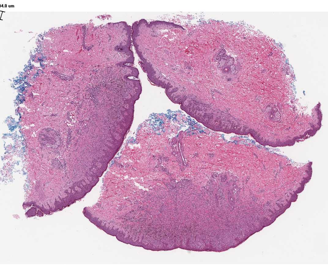 Imagen de Lesin cutnea en mujer de 26 aos/Cutaneous lesion in 26 y-o female.