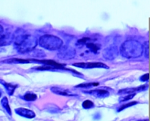 Imagen de leso do colo uterino