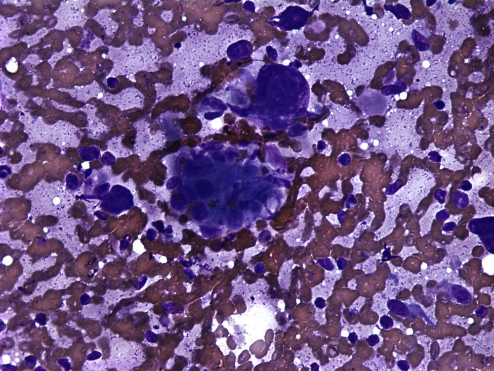 Imagen de Tumor ulcerado en varn de 25 aos/Ulcerated tumor in 25 year old male.