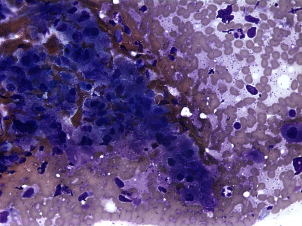 Imagen de Tumor ulcerado en varn de 25 aos/Ulcerated tumor in 25 year old male.