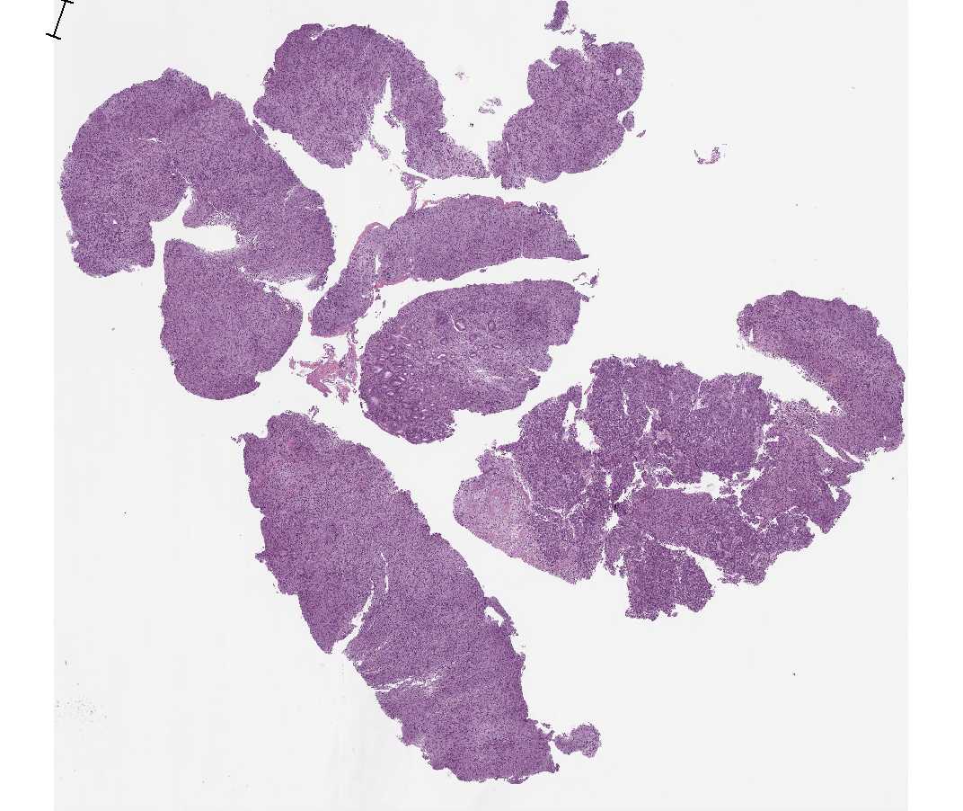 Imagen de Tumor gstrico ulcerado/Ulcerated gastric tumor.