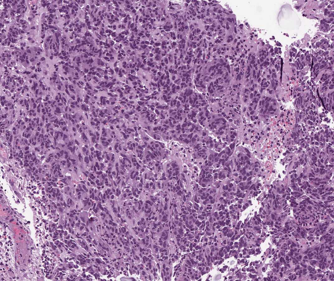 Imagen de Tumor gstrico ulcerado/Ulcerated gastric tumor.