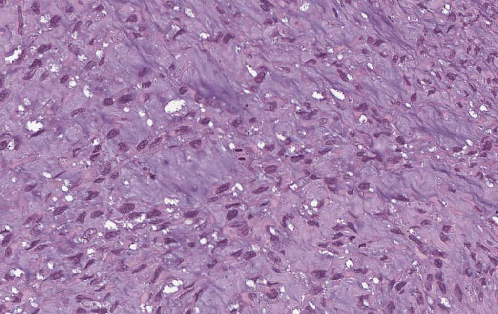 Imagen de Tumor de partes blandas en varn de 19 aos/Soft tissue tumor in 19 y-o male.