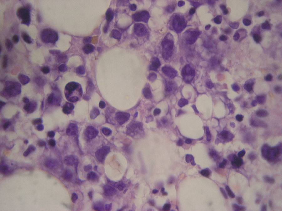 Imagen de Biopsia de mdula sea en varn de 36 aos/Bone marrow biopsy in 36 y-o male.