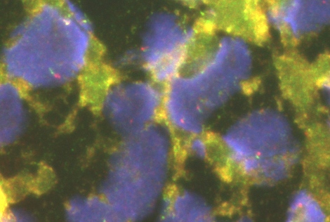 Imagen de Tumor de partes blandas en varn de 19 aos/Soft tissue tumor in 19 y-o male.