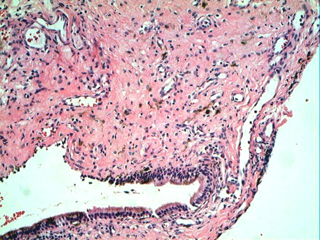 Imagen de Lesin polipoide del seno maxilar en paciente de 7 aos/Polypoid lesion of the maxillary sinus in 7 y-o patient.