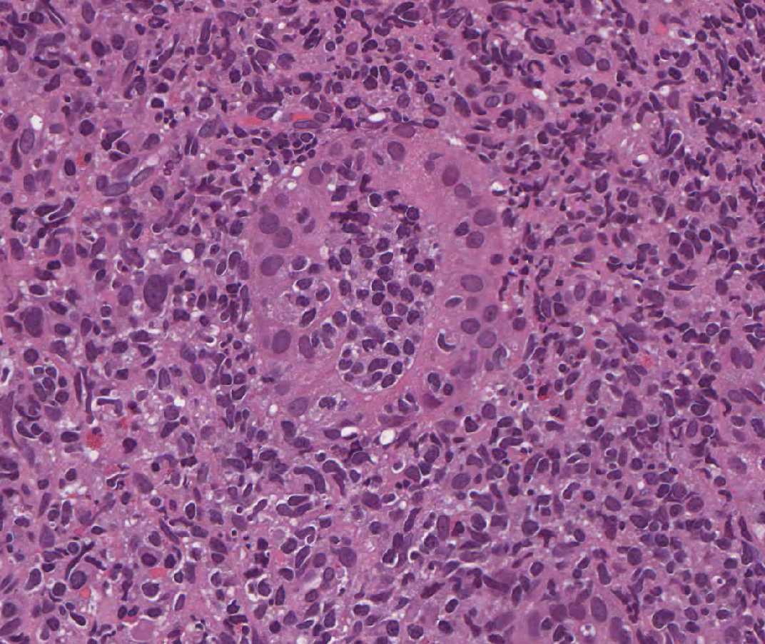 Imagen de Tumoracin gstrica en varn de 74 aos/Gastric tumour in 74 years old male.