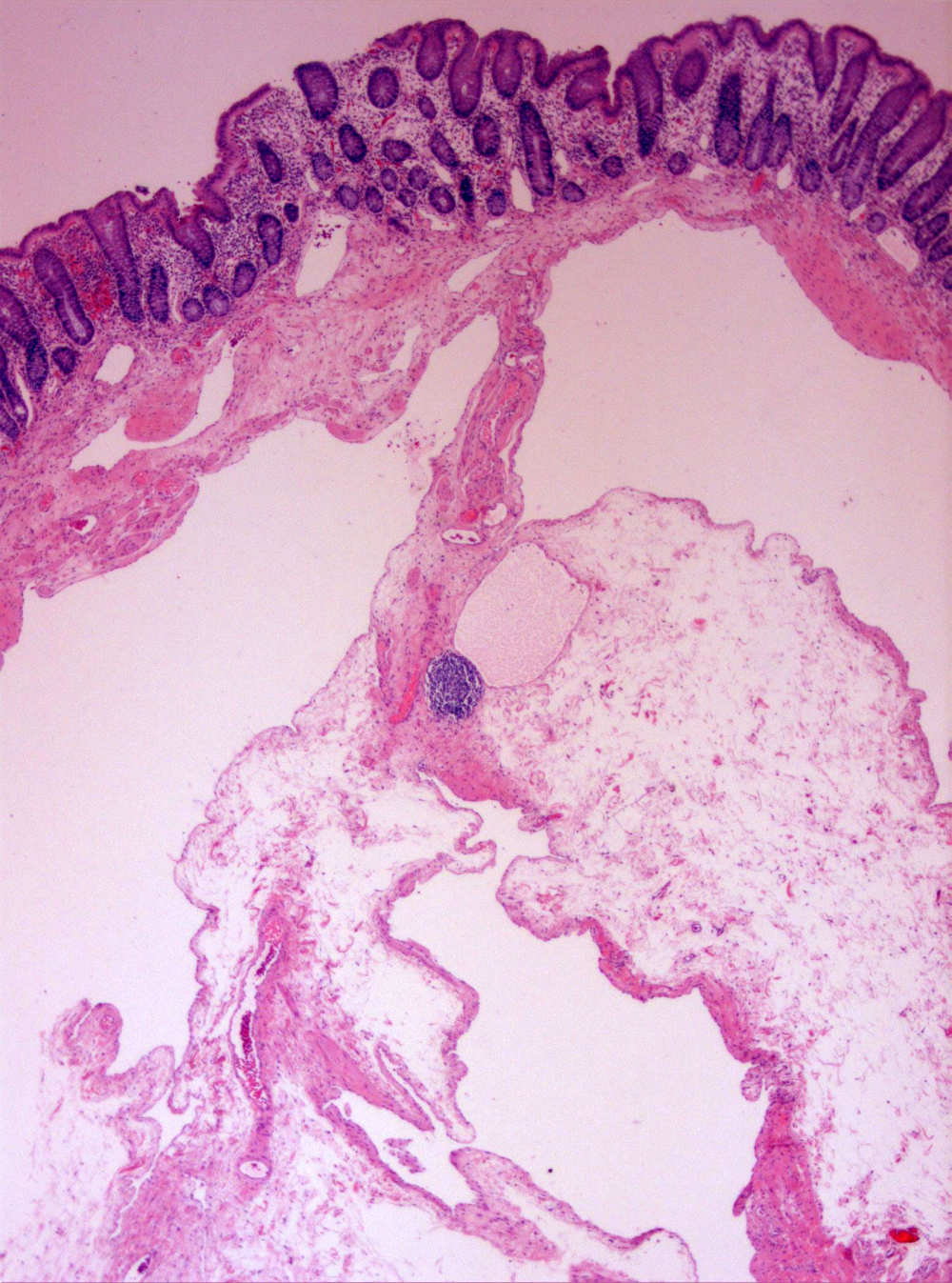 Imagen de Plipo sesil en colon ascendente/Sessile polyp in ascendant colon.