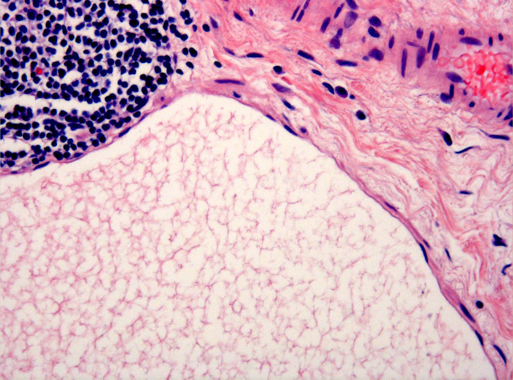 Imagen de Plipo sesil en colon ascendente/Sessile polyp in ascendant colon.
