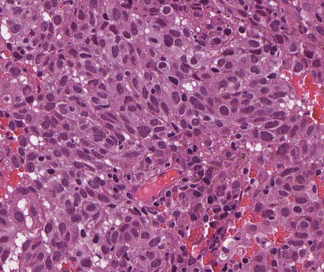 Imagen de Tumor esofgico en varn de 74 aos / Esophageal tumour in 74 y-o male.