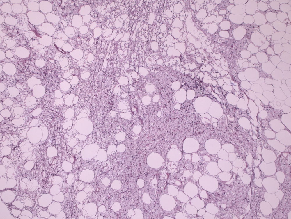 Imagen de Tumor mesentrico en un paciente de 78 aos/ Mesenteric tumor in 78-year-old male