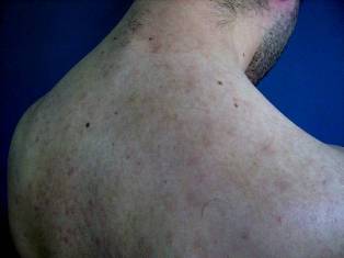 Imagen de Placas eritemato-violceas en dorso de manos/Erythematous patches on the dorsum of hands.