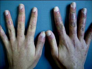 Imagen de Placas eritemato-violceas en dorso de manos/Erythematous patches on the dorsum of hands.