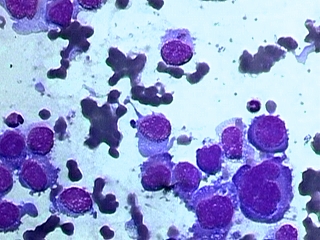 Imagen de Clulas no sangue perifrico