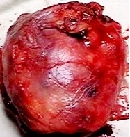 Imagen de Tumor Mediastinal y anemia en paciente joven / Anemia and Mediastinal mass in a young man