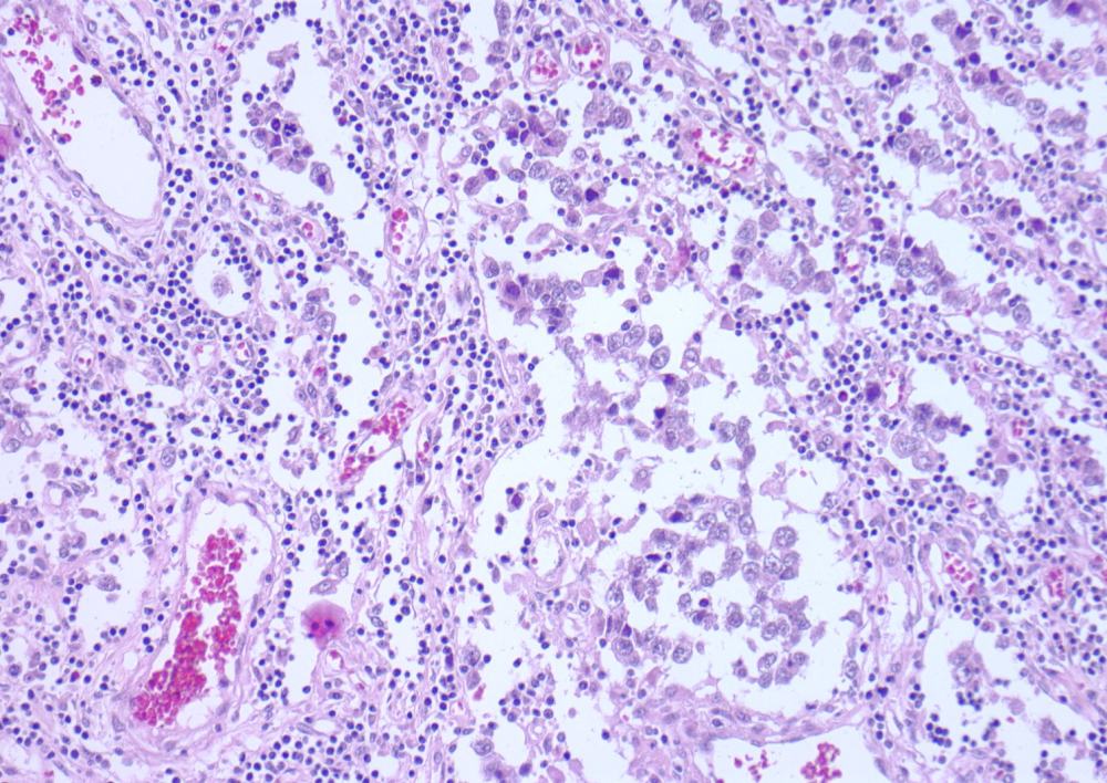 Imagen de Tumor Mediastinal y anemia en paciente joven / Anemia and Mediastinal mass in a young man