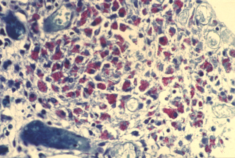 Imagen de lceras superficiales antrales en paciente VIH (+)/Antral superficial ulcers in HIV (+) patient.