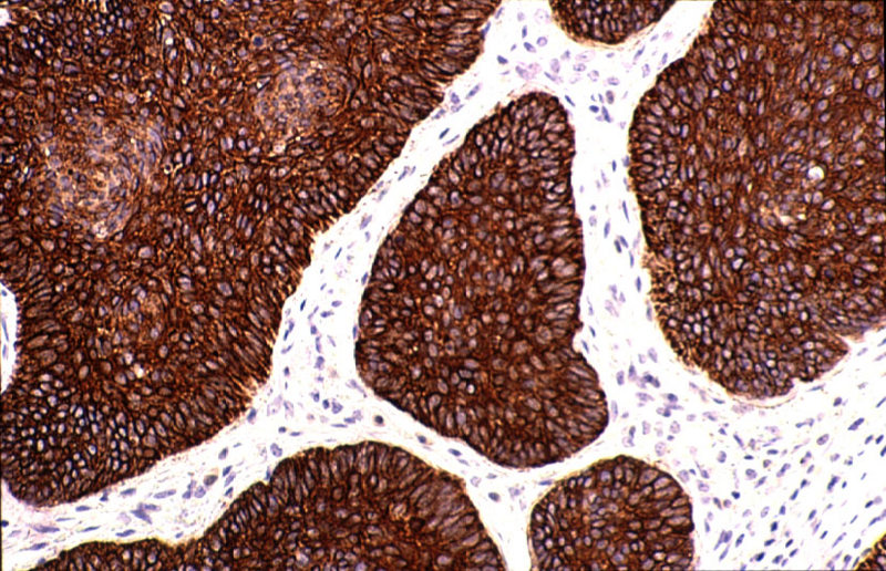 Imagen de Tumor ulcerado del margen anal/Ulcerated tumour on the anal margin.