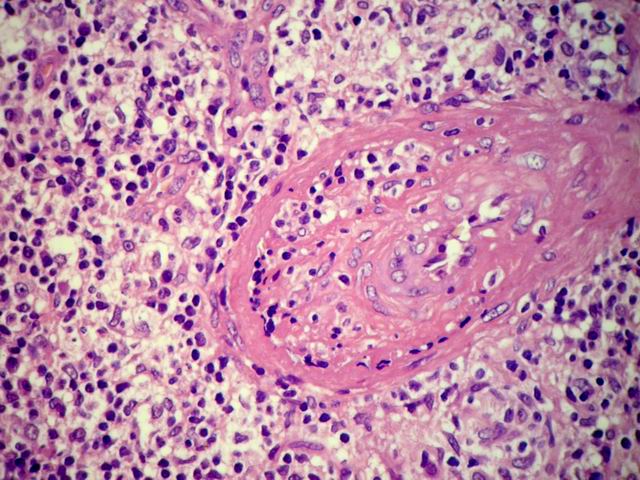 Imagen de Tumoracin larngea en paciente joven/Laryngeal tumour in young patient.