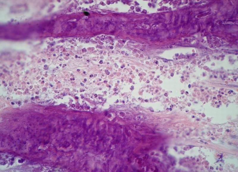 Imagen de Tumor de parrilla costal en paciente masculino de 15 aos.
