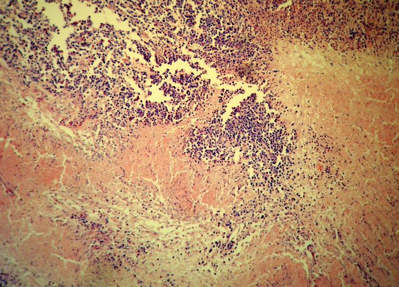 Imagen de Tumor de parrilla costal en paciente masculino de 15 aos.