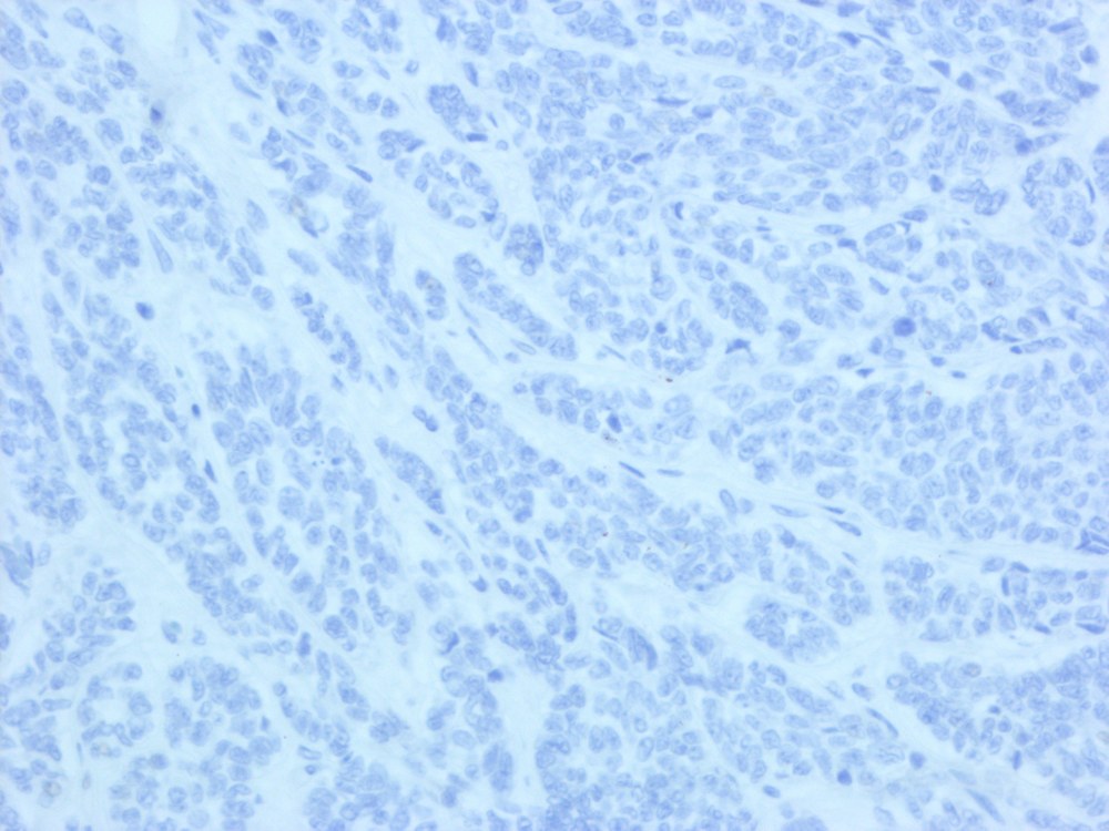 Imagen de Tumor subcutneo y de partes blandas en mujer de 73 aos/Subcutaneous soft tissue tumour in 73 y-o female