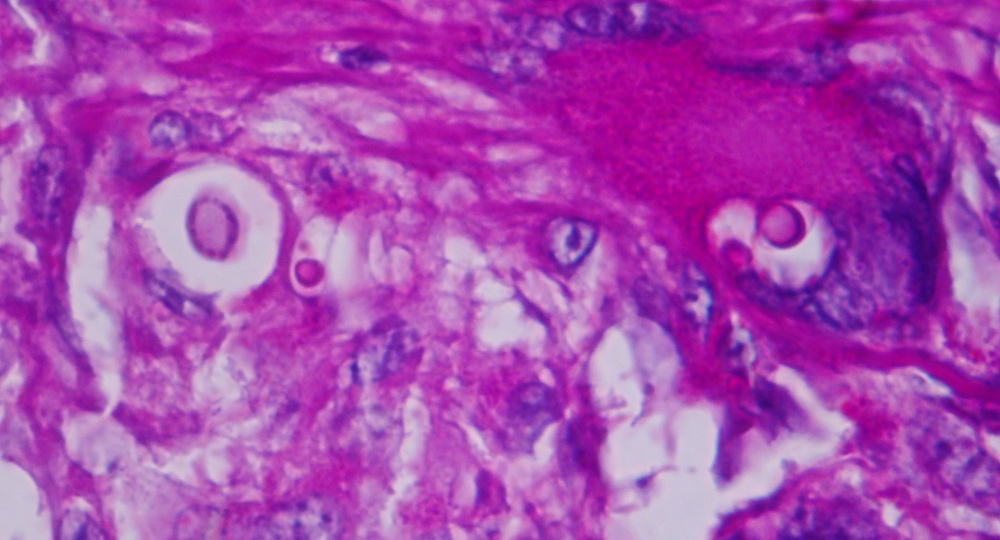 Imagen de Biopsia de ganglio linftico cervical / Cervical lymph node biopsy