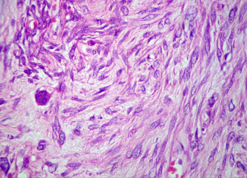 Imagen de Tumor mesentrico en mujer de 47 aos/Mesenteric tumour in 47 y-o female