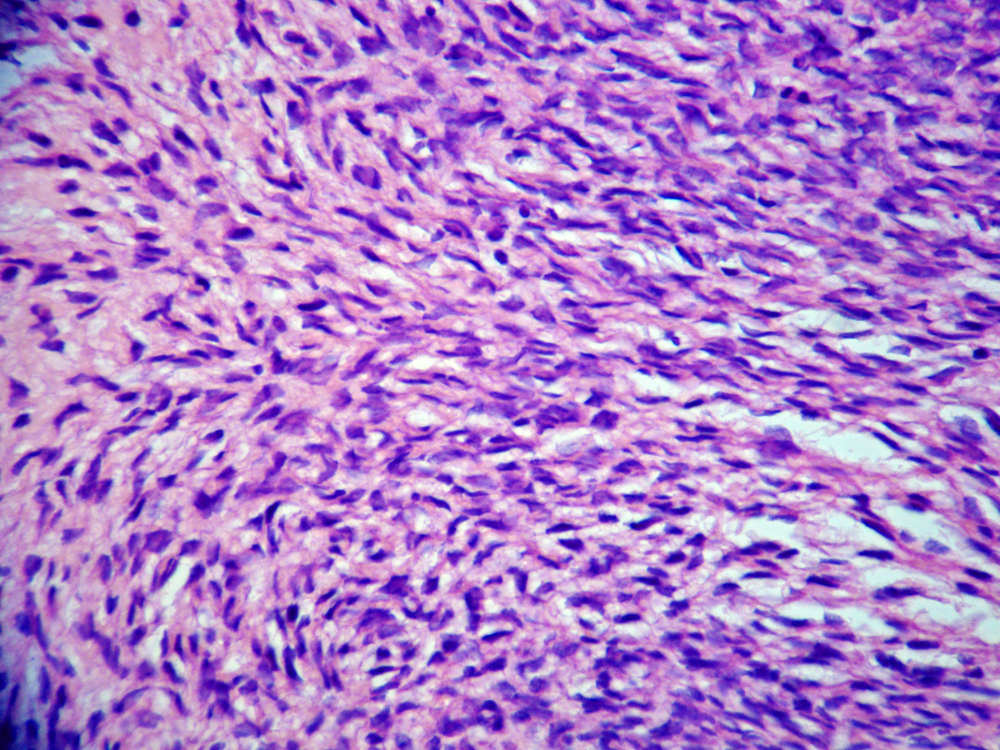 Imagen de Tumor de partes blandas de pared torcica/Soft tissue tumour of the thoracic wall.