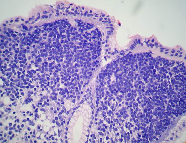 Imagen de Biopsia Gstrica en paciente con prdida de peso.