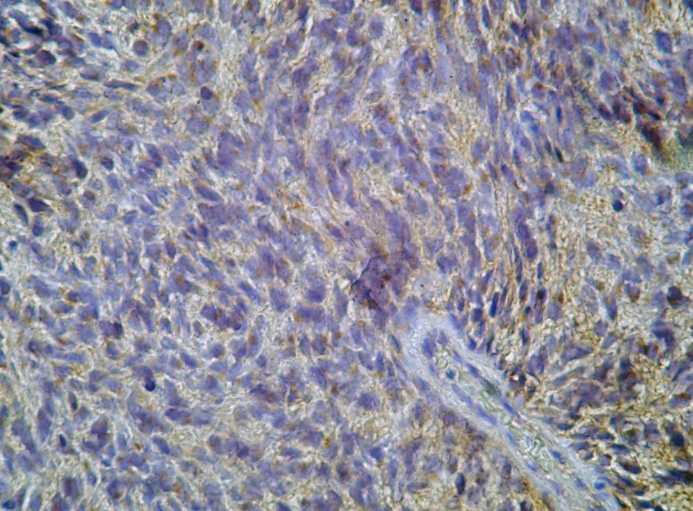 Imagen de Tumor de partes blandas de pared torcica/Soft tissue tumour of the thoracic wall.