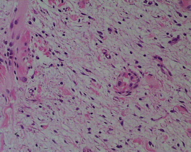 Imagen de Tumor de partes blandas en nio de 10 meses