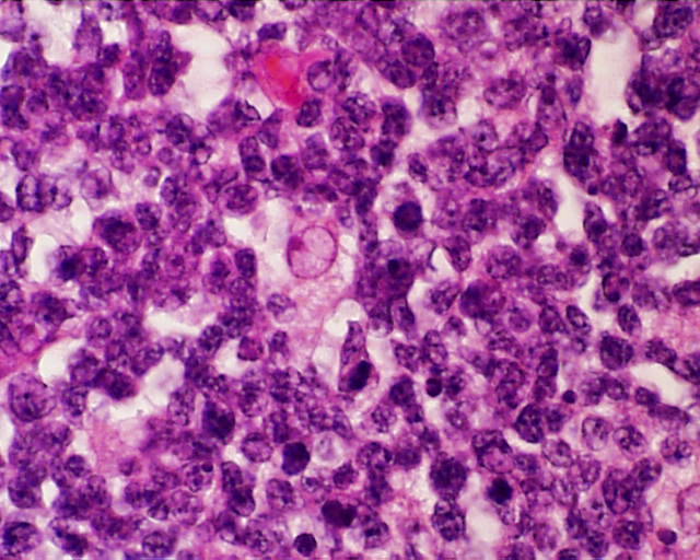 Imagen de Adenopata inguinal en paciente VIH.