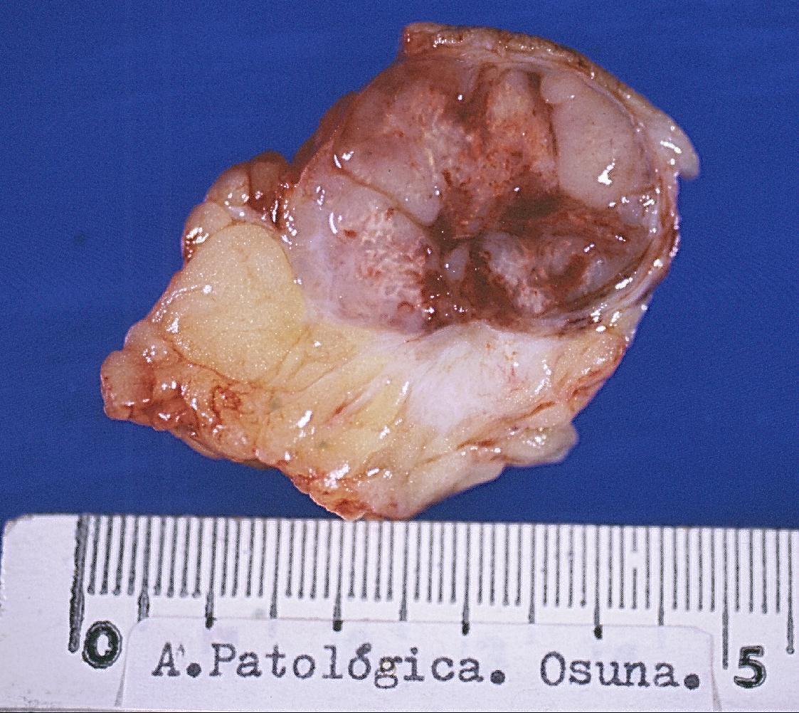 Imagen de Tumor de partes blandas en mujer de 60 aos.
