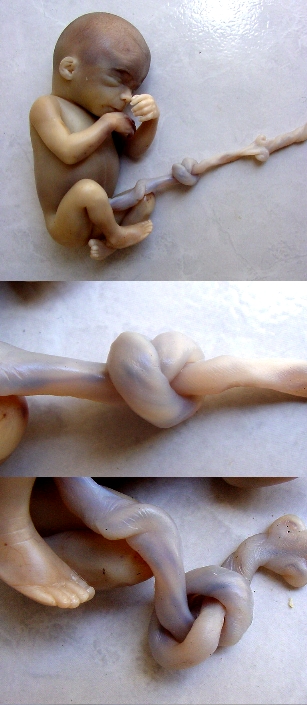 Imagen de N (nudo) de cordo umbilical