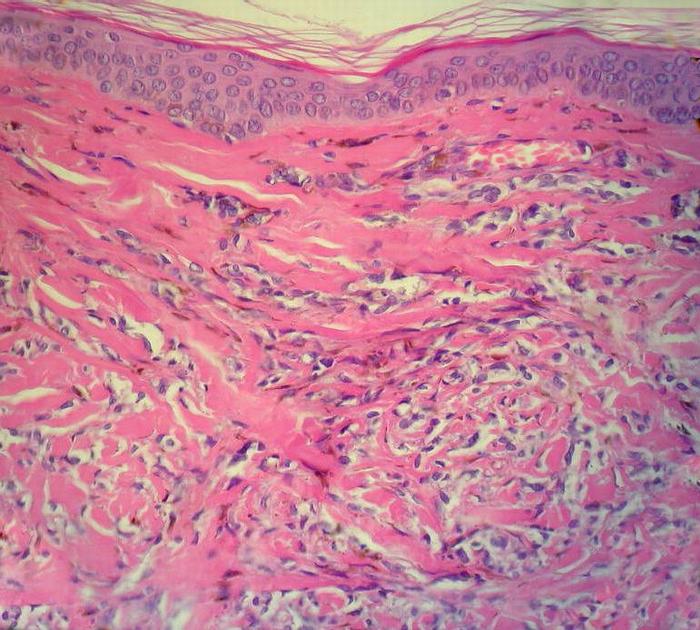 Imagen de Lesione papulare nell cuoio capelluto/Papular cutaneous lesion on the scalp