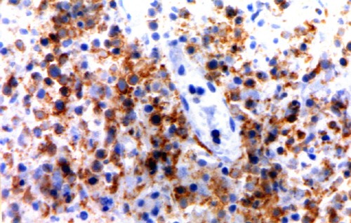 Imagen de Tumoracin escrotal en varn de 78 aos/Scrotal tumor in 78 year-old male.