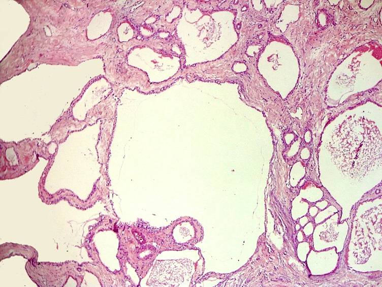 Imagen de Tumor pancretico / Pancreatic tumor.