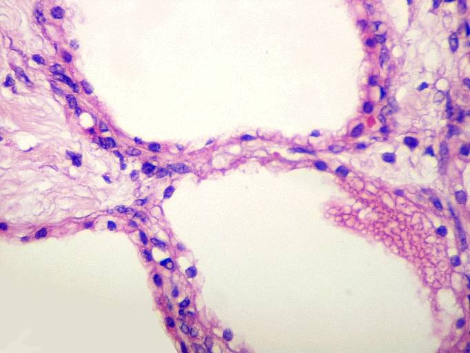 Imagen de Tumor pancretico / Pancreatic tumor.