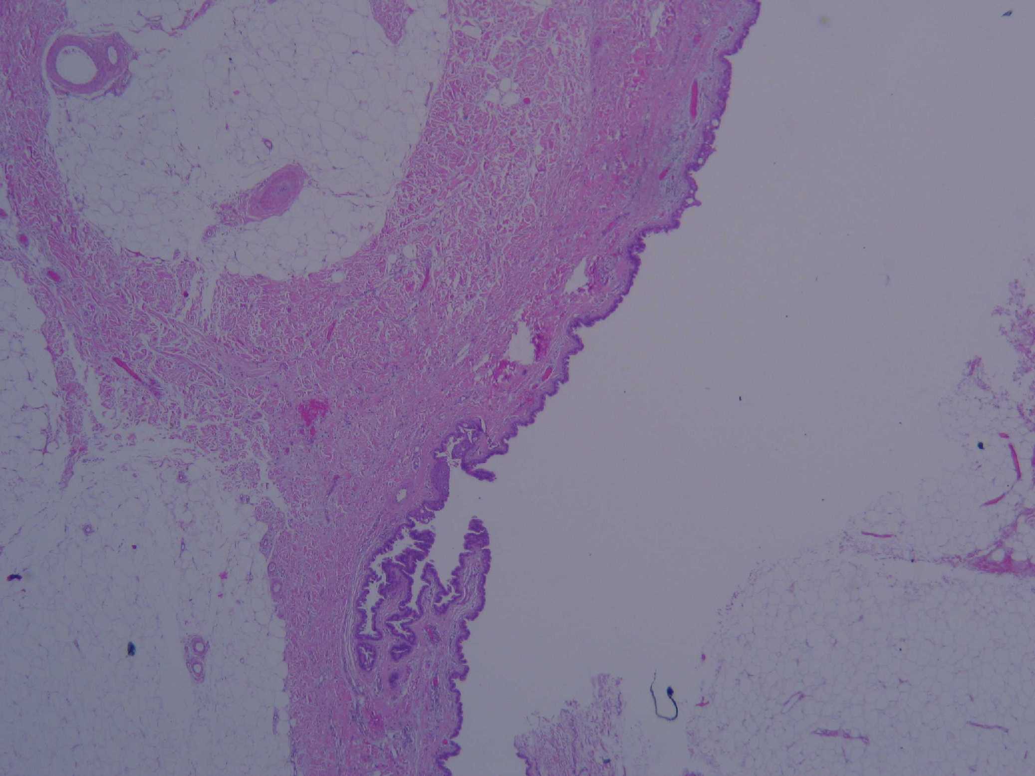 Imagen de Lesin qustica cutnea en nalga / Cutanous cystic lesion in buttock
