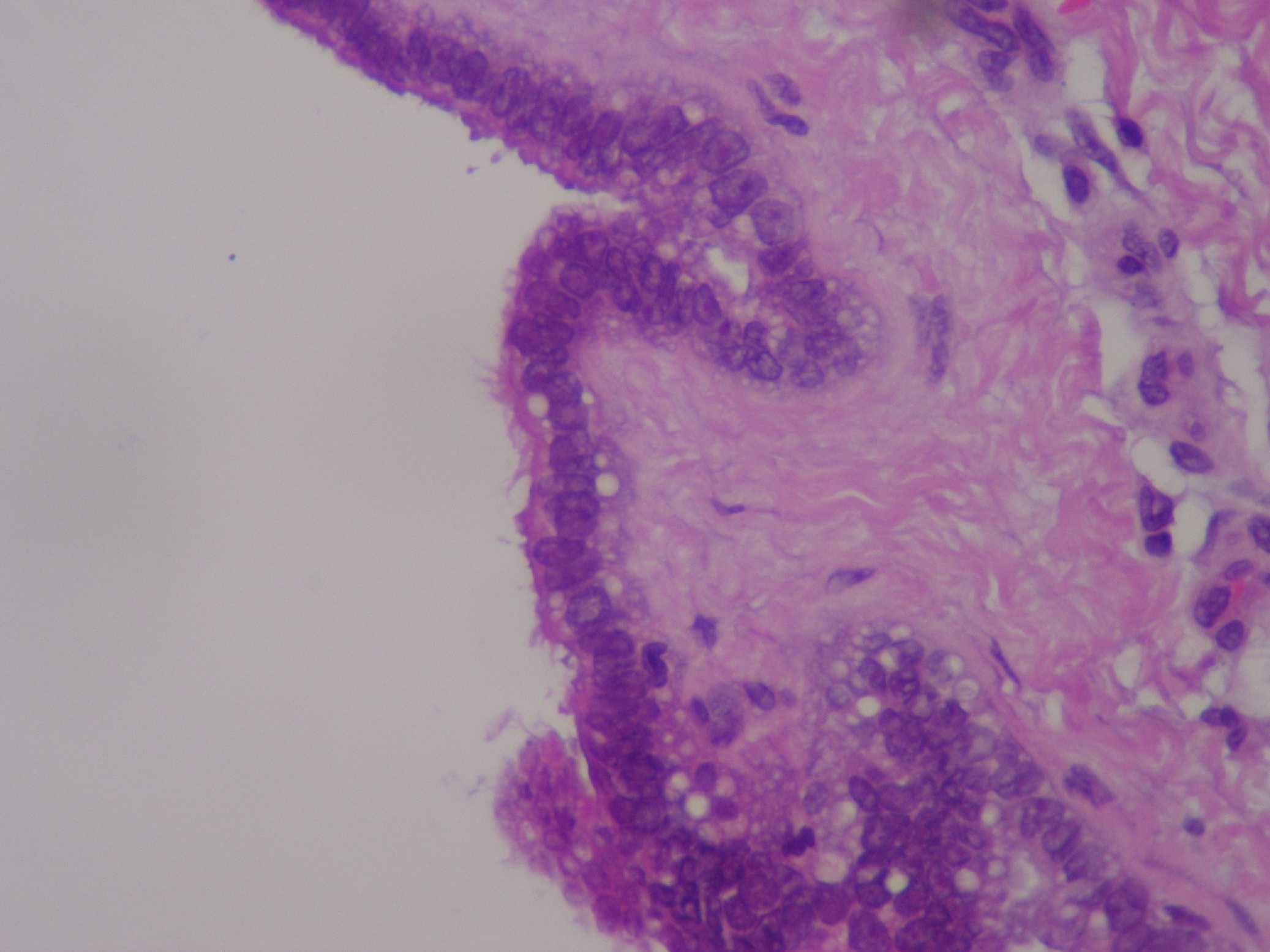 Imagen de Lesin qustica cutnea en nalga / Cutanous cystic lesion in buttock