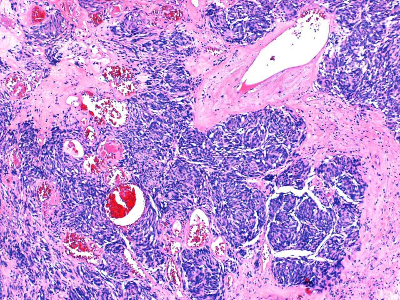 Imagen de Neoplasia Inusual en Biopsias Transrectales de Prstata / Uncommon  Prostatic Neoplasia On transrectal Biopsies.