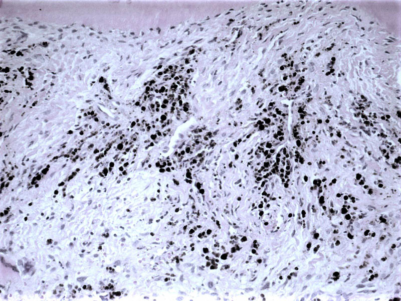 Imagen de Lesin qustica en maxilar superior.