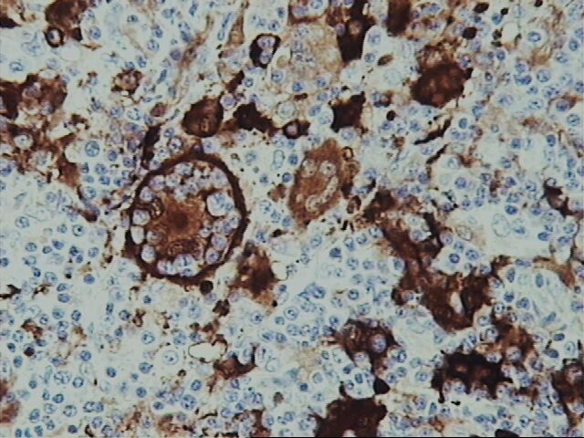 Imagen de Ganglio Linftico en varn de 60 aos con antecedentes de Linfoma de Hodgkin/Lymph node in 60 year-old male previously treated for Hodgkin disease.