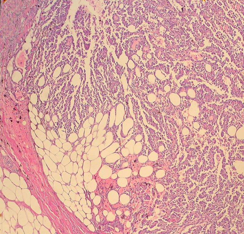 Imagen de Lesione nodulare della mammella destra in una donna di 73 anni/Nodular lesion of the right breast in a 73 years-old woman. 
