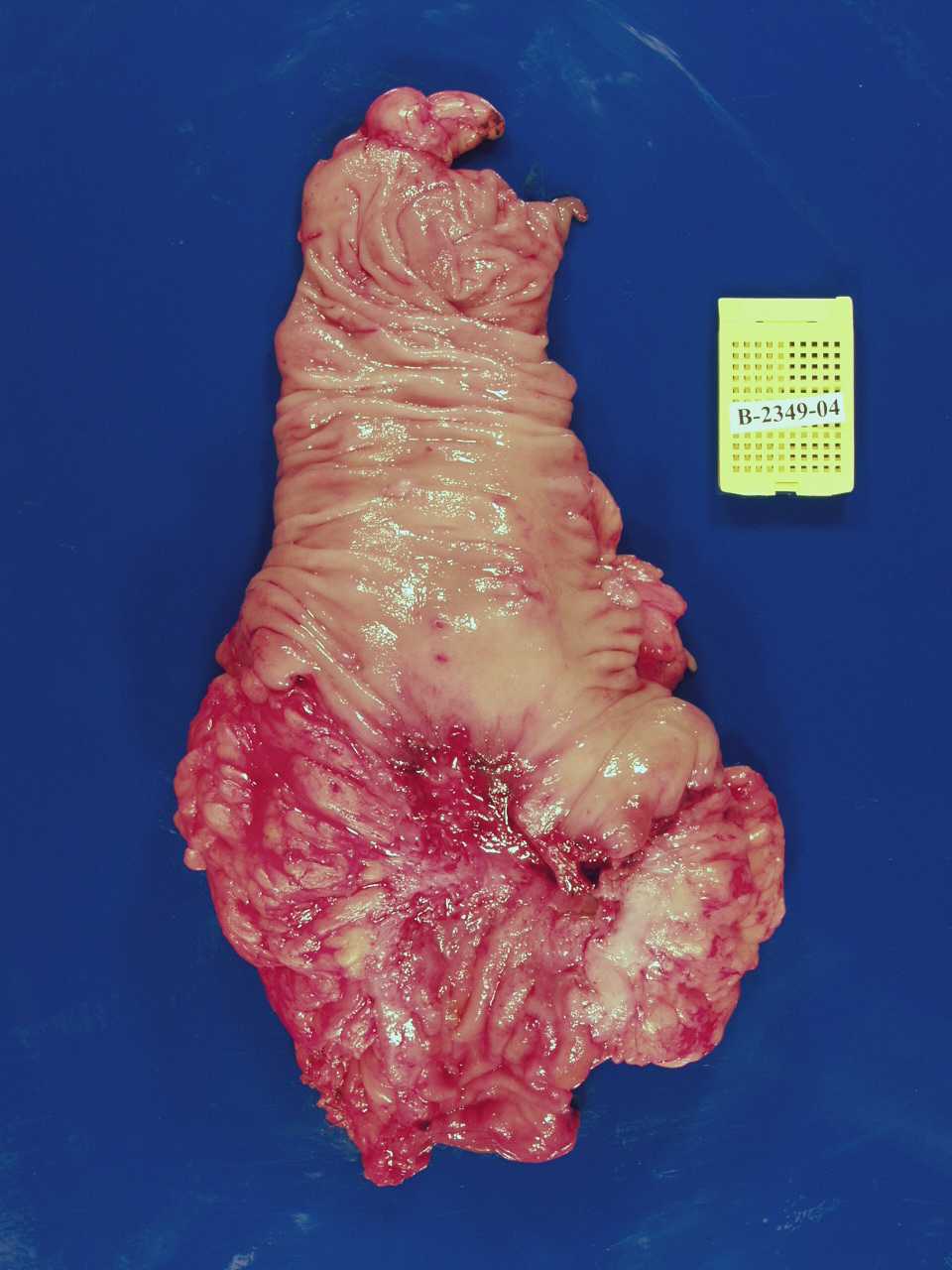 Imagen de Oclusin intestinal en varn de 48 aos / Intestinal occlusion in 48 years old male.