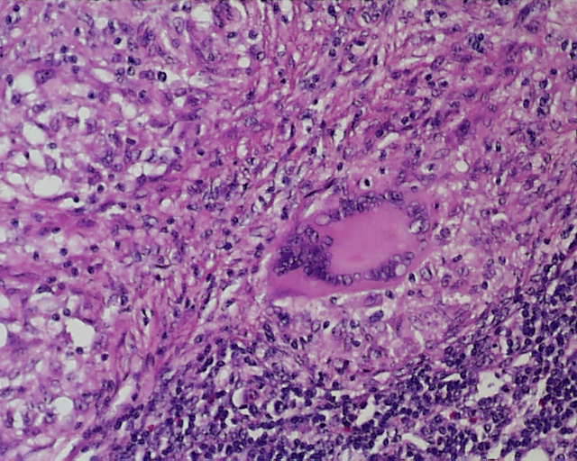 Imagen de Oclusin intestinal en varn de 48 aos / Intestinal occlusion in 48 years old male.