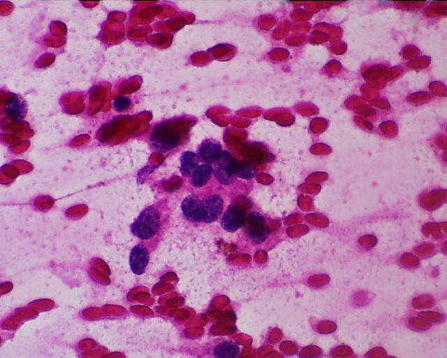 Imagen de Ndulos mltiples hepticos en varn de 76 aos / Multiple liver nodules in 76 years old male.