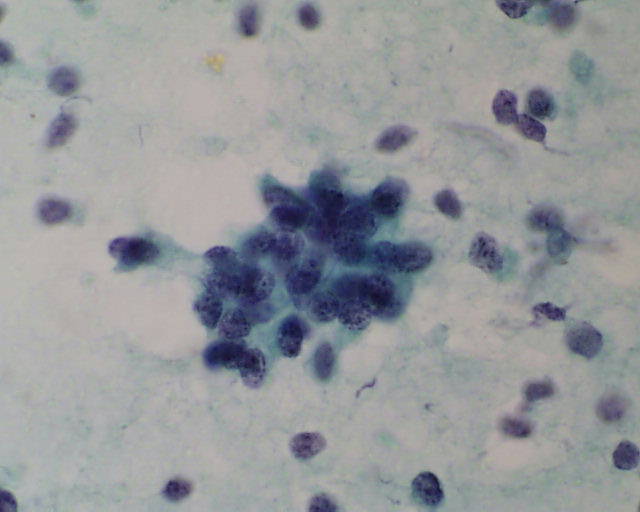 Imagen de Ndulos mltiples hepticos en varn de 76 aos / Multiple liver nodules in 76 years old male.