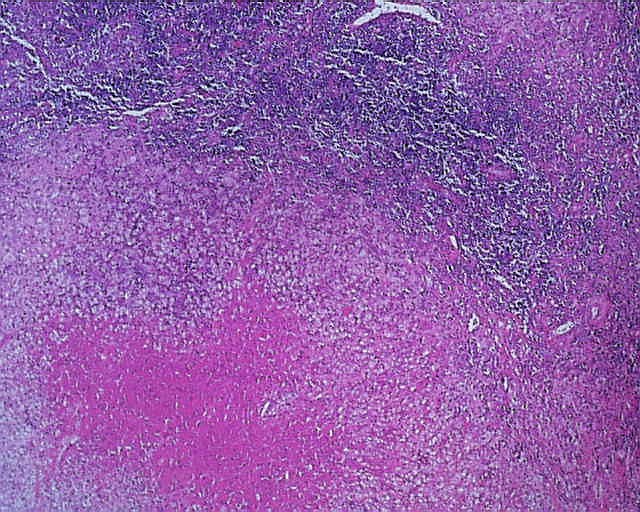 Imagen de Ganglio linftico laterocervical en paciente de 18 aos / Lateral cervical lymph node in 18 years old patient.